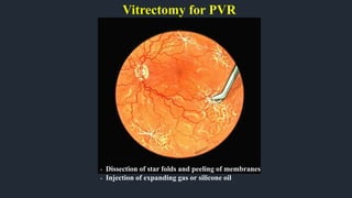 Vitrectomy for PVR
• Dissection of star folds and peeling of membranes
• Injection of expanding gas or silicone oil
 