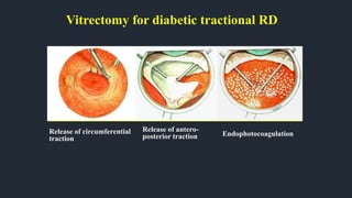 Vitrectomy for diabetic tractional RD
Release of circumferential
traction
Release of antero-
posterior traction Endophotocoagulation
 