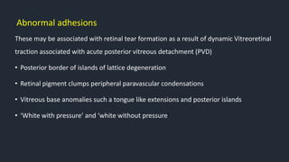 Abnormal adhesions
These may be associated with retinal tear formation as a result of dynamic Vitreoretinal
traction associated with acute posterior vitreous detachment (PVD)
• Posterior border of islands of lattice degeneration
• Retinal pigment clumps peripheral paravascular condensations
• Vitreous base anomalies such a tongue like extensions and posterior islands
• ‘White with pressure’ and ‘white without pressure’
 