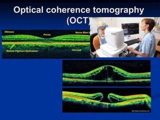 Tractional Rd Oct Retinal Detachment for medical students | PPT