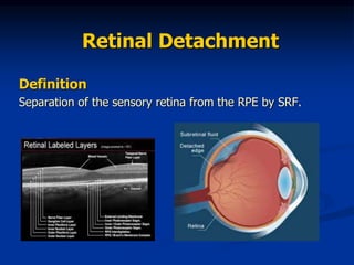 Retinal Detachment for medical students | PPT