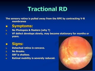 Retinal Detachment for medical students | PPT
