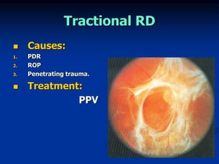 Mild Tractional Rd Retinal Detachment for medical students | PPT