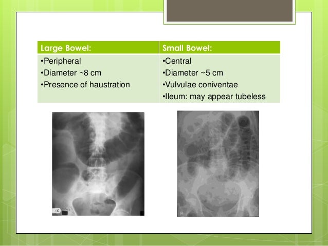 Intestinal Obstruction