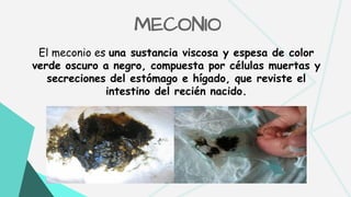 SÍNDROME DE ASPIRACIÓN MECONIAL Y ATELECTASIA | PDF | Pregnancy ...