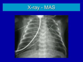 X-ray - MAS
 