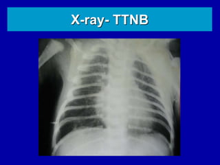 X-ray- TTNB
 