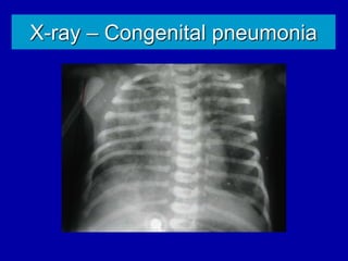 X-ray – Congenital pneumonia
 