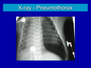 X-ray - Pneumothorax
 