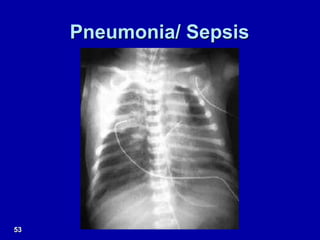 Pneumonia/ Sepsis
53
 
