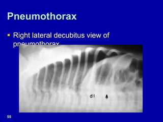 Pneumothorax
 Right lateral decubitus view of
pneumothorax
55
 