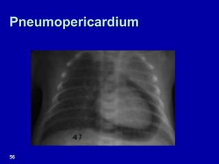 Pneumopericardium
56
 