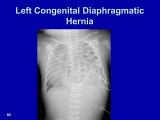 Left Congenital Diaphragmatic
Hernia
82
 