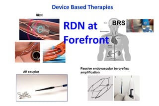 Renal Denervation in Resistant Hypertension 23.pptx