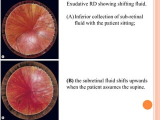 Retinal detachment presentation | PPTX