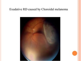 Retinal detachment presentation | PPTX