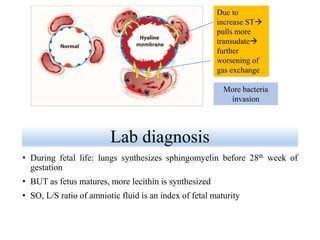 Lab diagnosis
• During fetal life: lungs synthesizes sphingomyelin before 28th week of
gestation
• BUT as fetus matures, more lecithin is synthesized
• SO, L/S ratio of amniotic fluid is an index of fetal maturity
Due to
increase ST
pulls more
transudate
further
worsening of
gas exchange
More bacteria
invasion
 