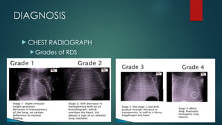 Kinder Rds Grading Respiratory Distress Syndrome Among Neonates | PPTX