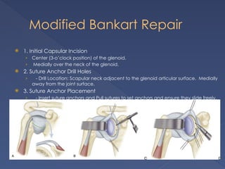 Recurrent dislocation shoulder orthopaedic | PPTX