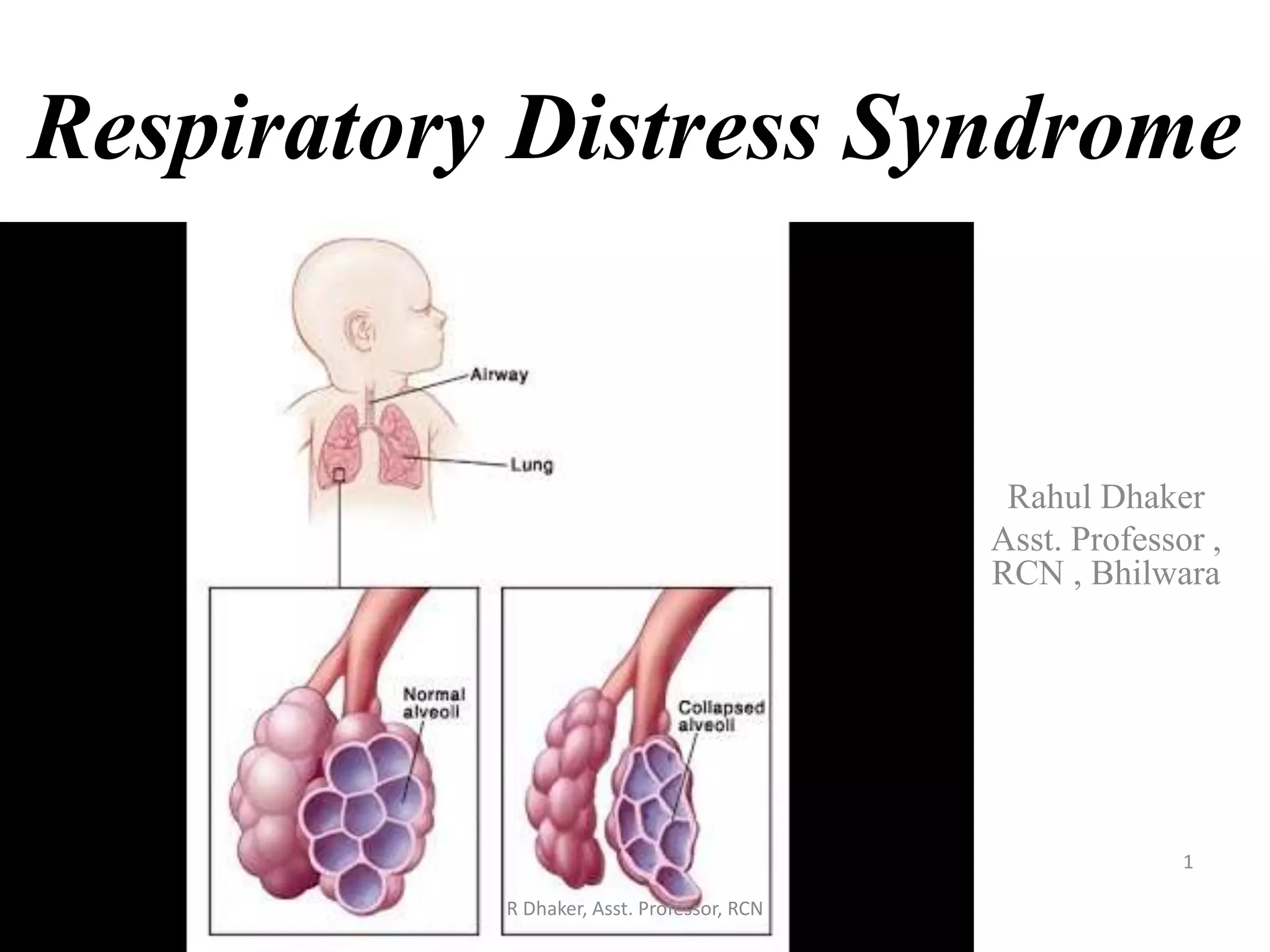 respiratory distress syndrome..... ppt by rahul dhaker | PPSX