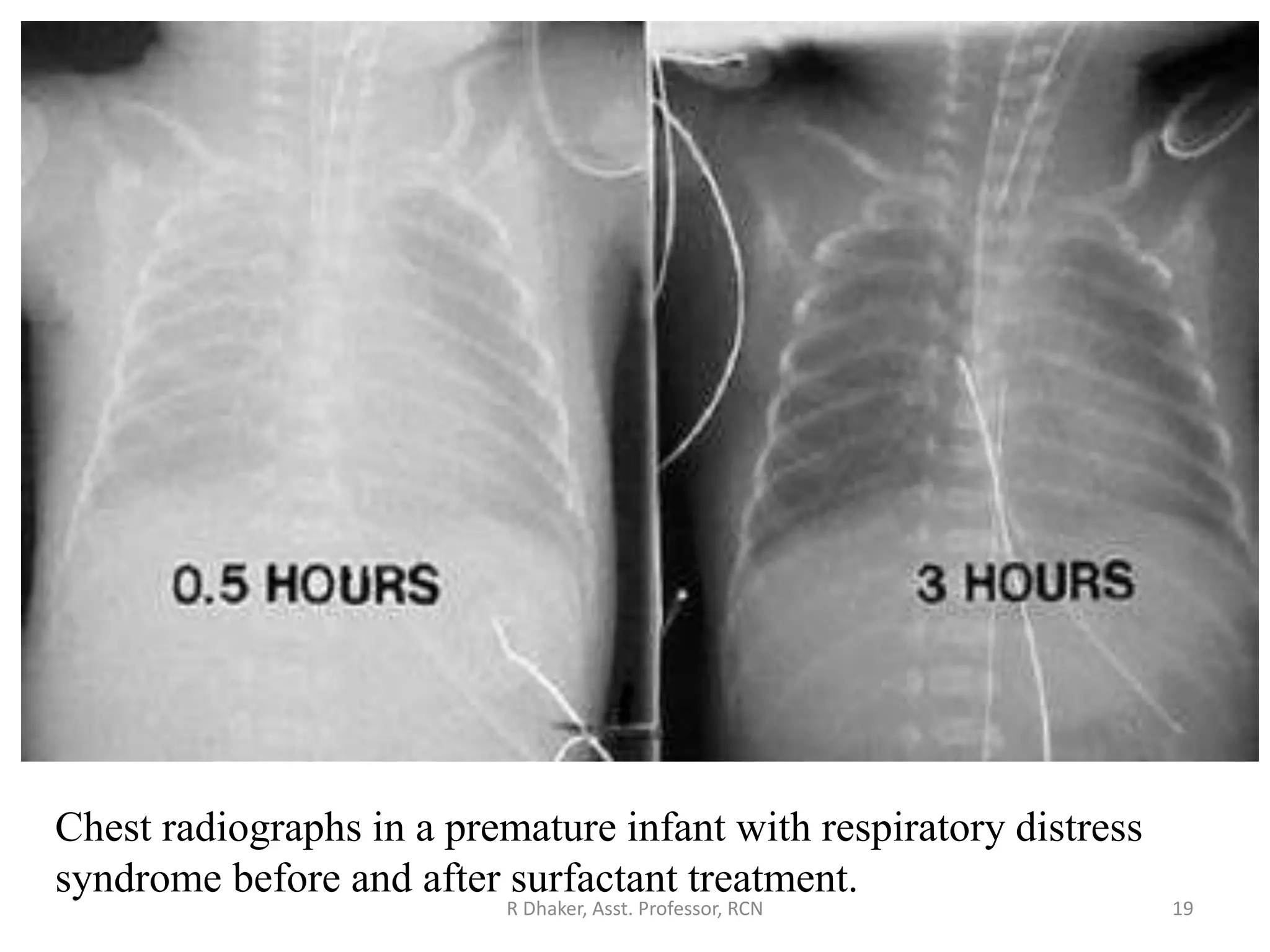 Infant Rds respiratory distress syndrome..... ppt by rahul dhaker | PPSX
