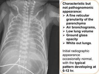 Air Bronchogram Rds Respiratory Distress(RDS) | PPTX