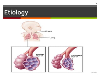 RDS (neonate respiratory distress syndrome) | PPTX