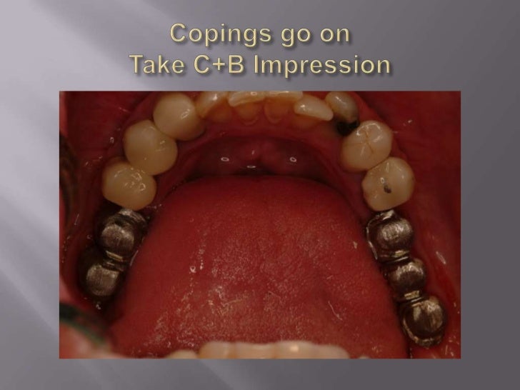 long-island-dental-implant-specialist-presents-restorative-benefits-of-using-a-restorative-driven-surgical-practice-11-728.jpg?cb=1288907430