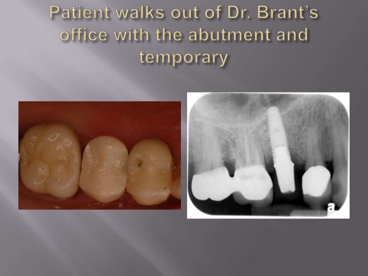 long-island-dental-implant-specialist-presents-restorative-benefits-of-using-a-restorative-driven-surgical-practice-3-728.jpg?cb=1288907430