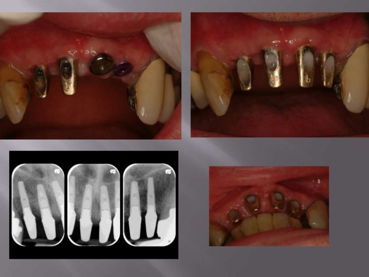 long-island-dental-implant-specialist-presents-restorative-benefits-of-using-a-restorative-driven-surgical-practice-7-728.jpg?cb=1288907430