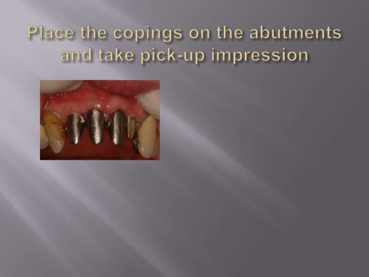 long-island-dental-implant-specialist-presents-restorative-benefits-of-using-a-restorative-driven-surgical-practice-8-728.jpg?cb=1288907430