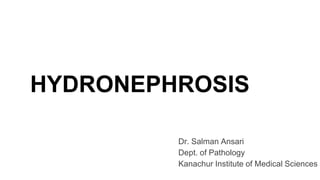 HYDRONEPHROSIS
Dr. Salman Ansari
Dept. of Pathology
Kanachur Institute of Medical Sciences
 