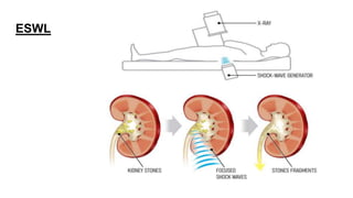 Renal stone diseases - General Medicine - RDT | PPTX