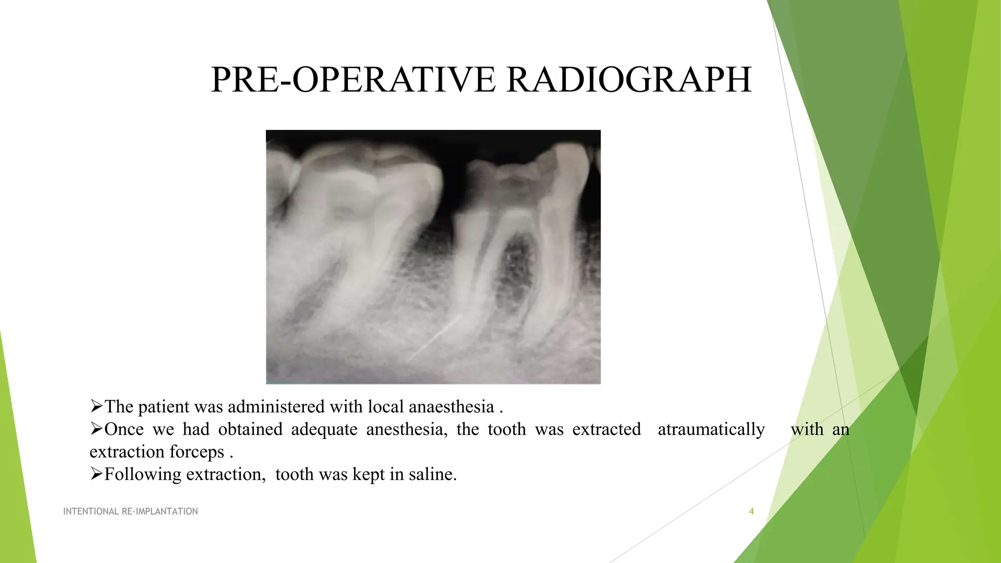Pre Extraction Radiograph Re-implantationgoodforendodonticsss.pptx
