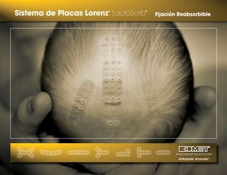 Anticipate. Innovate.TM
Sistema de Placas Lorenz®
LactoSorb®
Fijación Reabsorbible
 