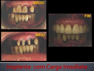 INÍCIOFIMMEIOImplante  com Carga Imediata     