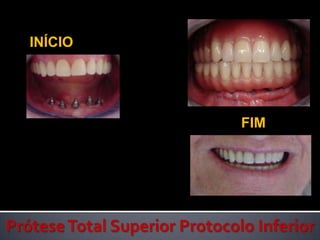 INÍCIO FIM Prótese Total Superior Protocolo Inferior      