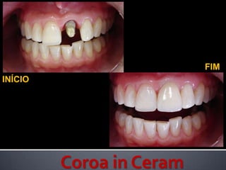      FIMINÍCIOCoroa in Ceram