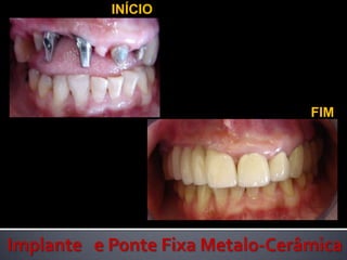INÍCIO          FIMImplante   e Ponte Fixa Metalo-Cerâmica