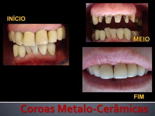 INÍCIOMEIO     FIMCoroas Metalo-Cerâmicas