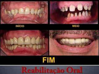 INÍCIOMEIOFIMReabilitação Oral