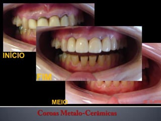 INÍCIOFIMMEIOCoroas Metalo-Cerâmicas