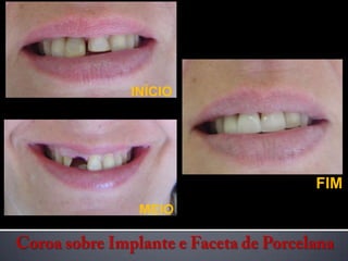 INÍCIOFIMMEIOCoroa sobre Implante e Faceta de Porcelana