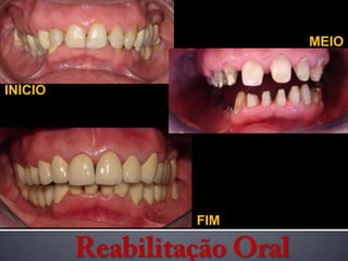 MEIO INÍCIO FIM Reabilitação Oral 
