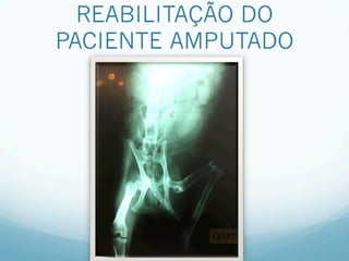REABILITAÇÃO DO
PACIENTE AMPUTADO
 