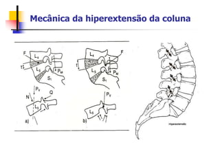 Mecânica da hiperextensão da coluna
 