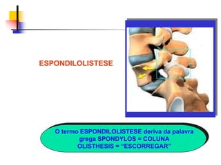 ESPONDILOLISTESE
O termo ESPONDILOLISTESE deriva da palavra
grega SPONDYLOS = COLUNA
OLISTHESIS = “ESCORREGAR”
 