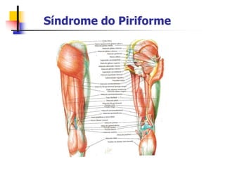 Síndrome do Piriforme
 