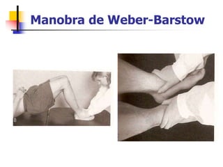 Manobra de Weber-Barstow
 