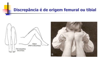 Discrepância é de origem femural ou tibial
 